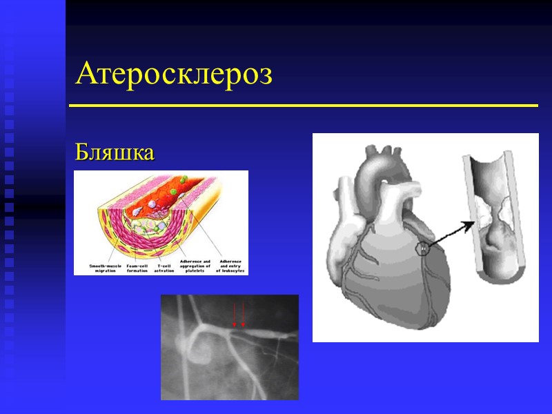 Атеросклероз Бляшка